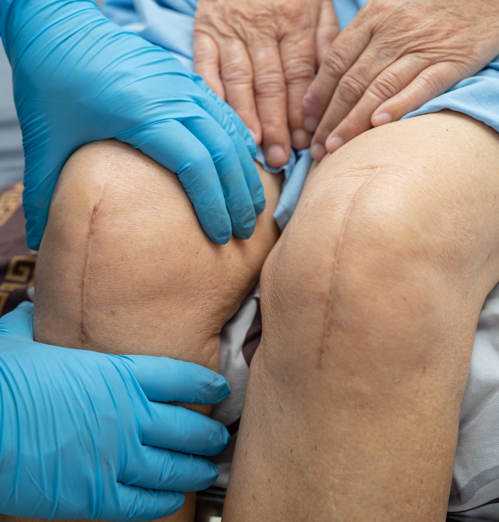 Rehabilitacja po artroskopii kolana